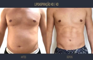 Imagem frontal de um paciente masculino após Lipoaspiração HD, demonstrando a definição muscular e o contorno corporal resultante do procedimento cirúrgico.