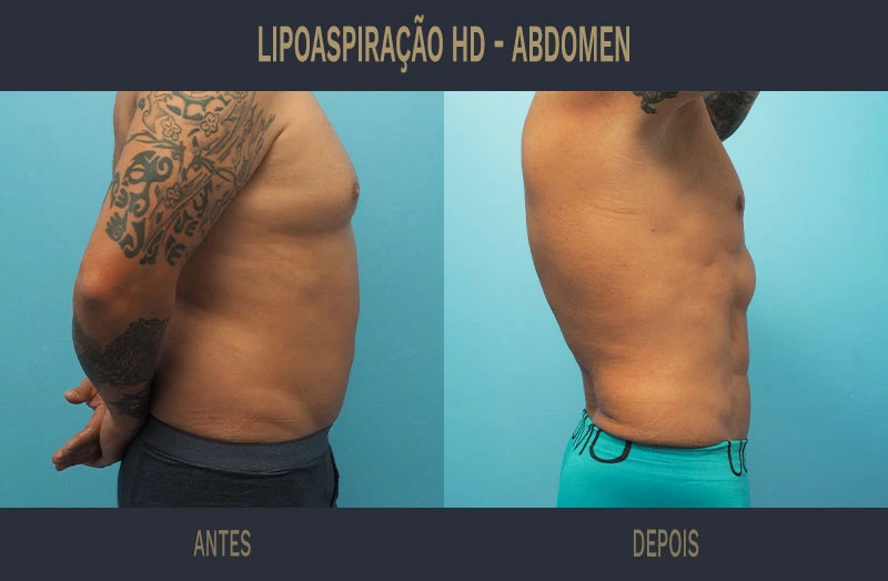 Lipoaspiração de Alta Definição HD - Coimbra e Lisboa - Dr. Ricardo ...
